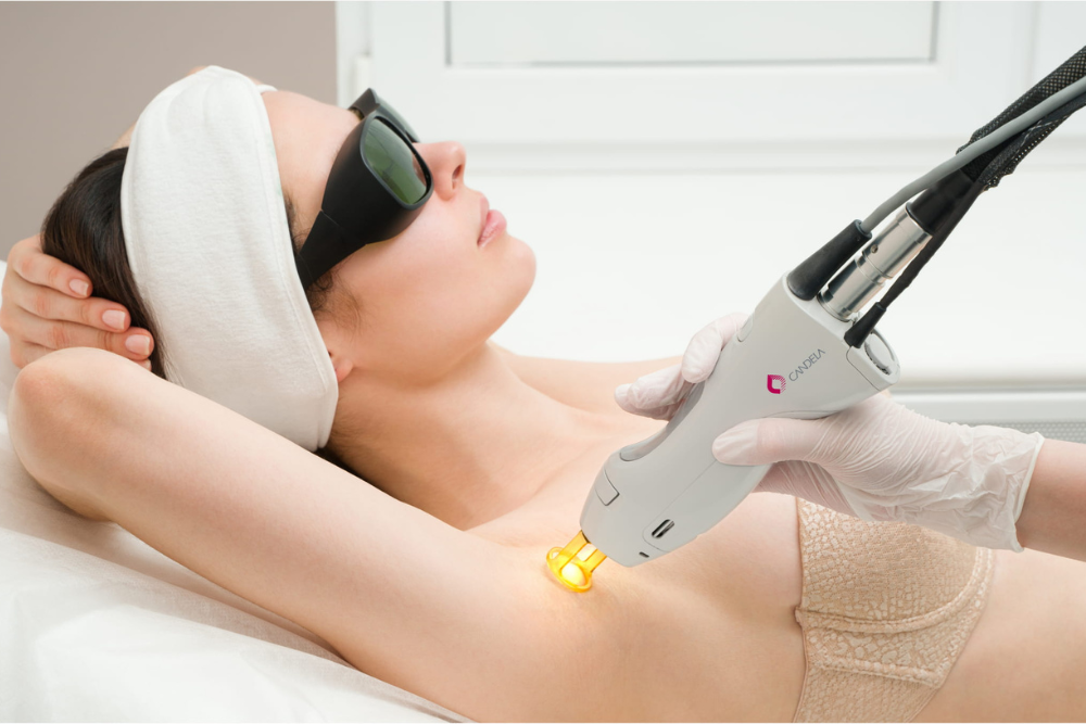 Laser Hair Removal